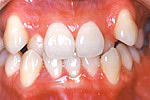 歯を抜かない矯正歯科治療