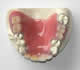 プラスチック義歯（部分入れ歯）