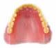 プラスチック義歯（総入れ歯）