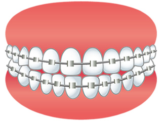 歯を抜かない矯正歯科治療、床矯正、非抜歯矯正など